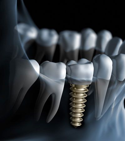 implantes dentales pamplona