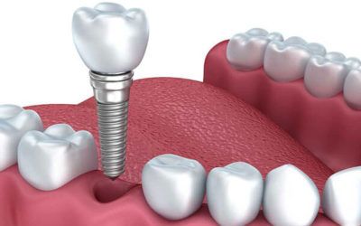 Implantes dentales precios Pamplona