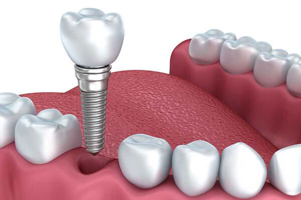 Implantes dentales precios Pamplona