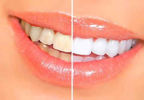 clinica blanqueamiento dental pamplona