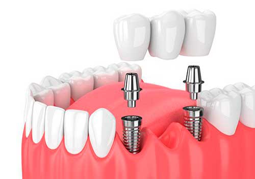 clinica implantes dentales pamplona